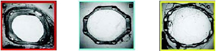 Superior acute gain-more vessel area - Flexia – Cobalt Chromium Coronary Stent System - Nano Therapeutics Pvt. Ltd. - Heart Stent Manufacturing Company Surat, India