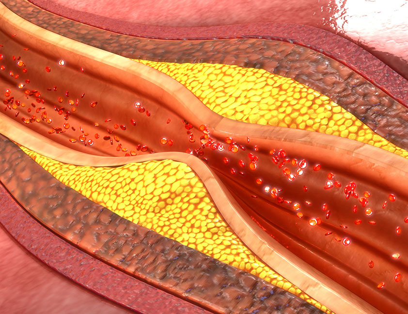 Coronary Artery Disease (CAD) - Patient Area - Nano Therapeutics Pvt. Ltd. - Heart Stent Manufacturing Company Surat, India